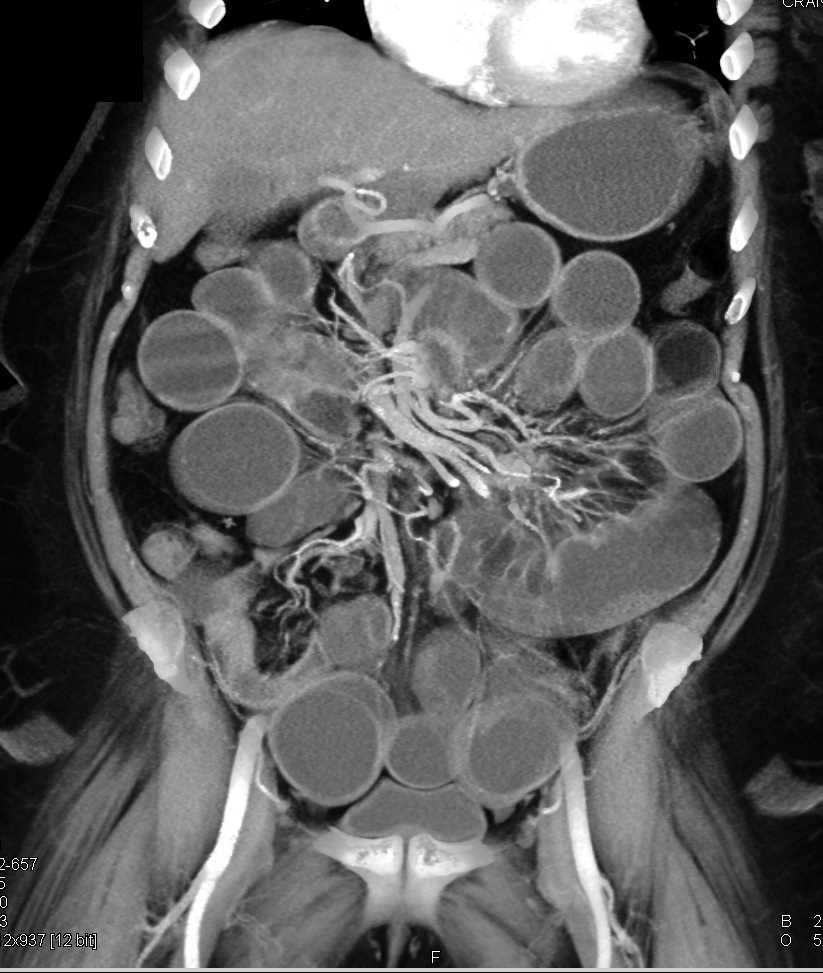 Crohn's Disease and Small Bowel Obstruction - CTisus CT Scan