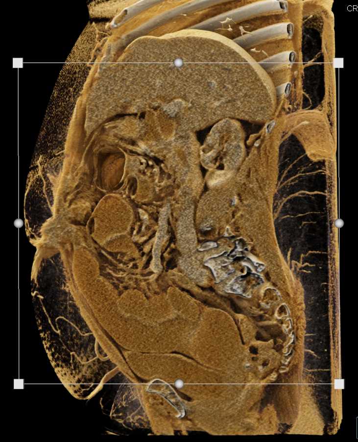 Crohn's Disease and Small Bowel Obstruction - CTisus CT Scan