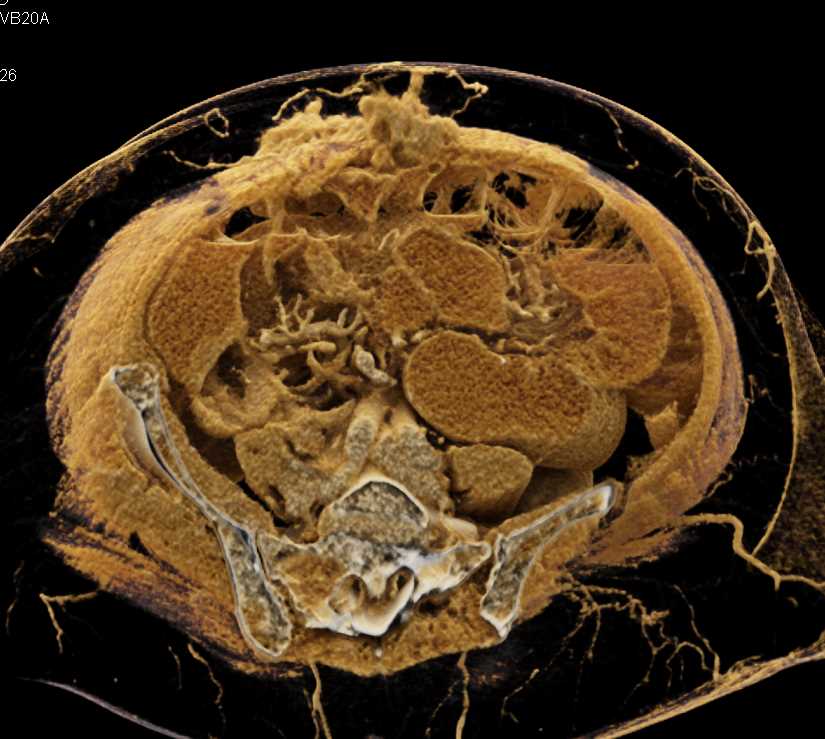 Crohns Disease and Small Bowel Obstruction - CTisus CT Scan