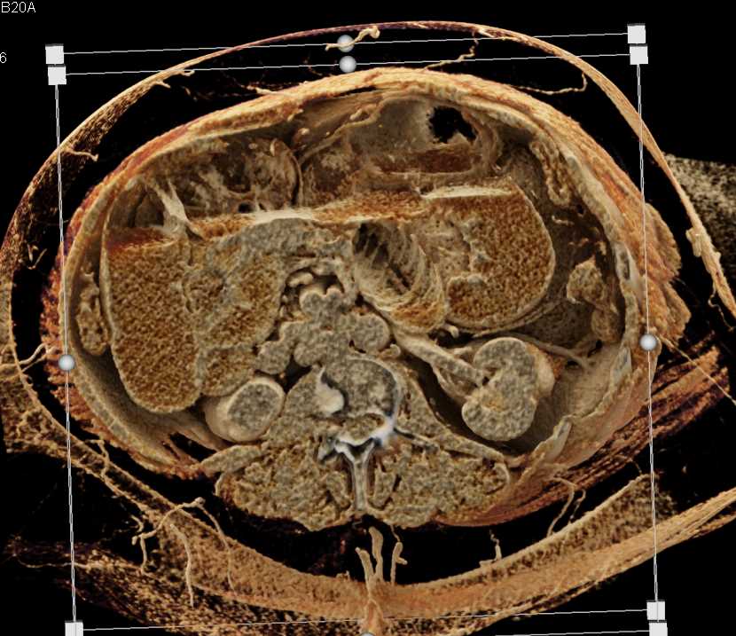 Crohns Disease and Small Bowel Obstruction - CTisus CT Scan