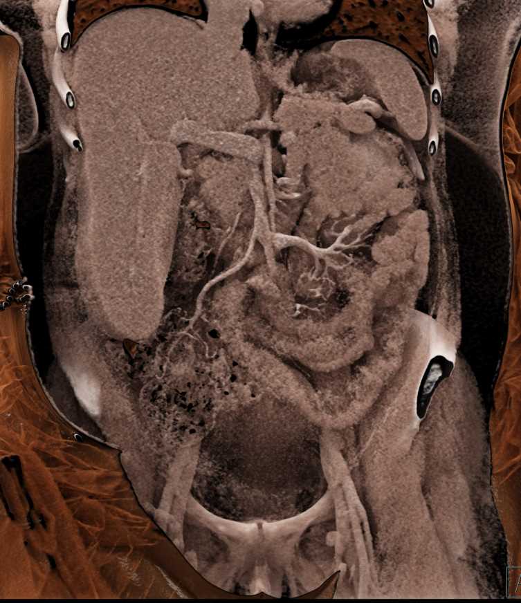 Thickened Small Bowel Pattern - CTisus CT Scan