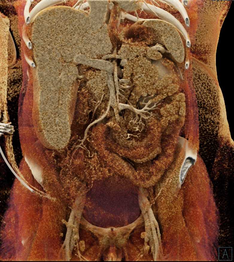Thickened Small Bowel Pattern - CTisus CT Scan