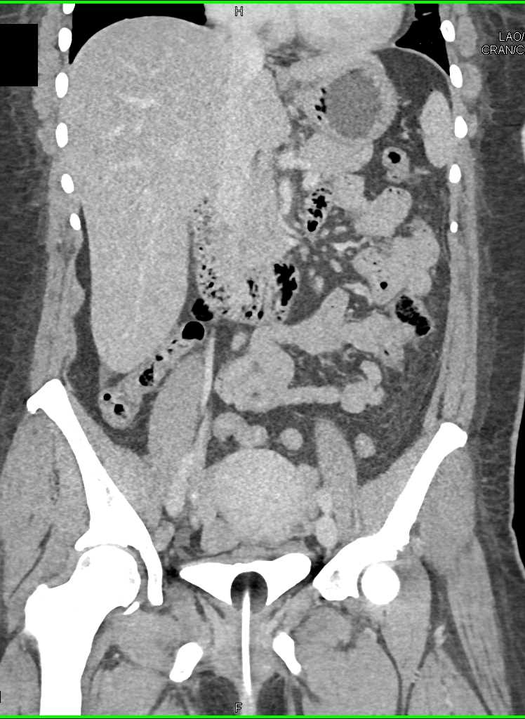CTisus CT Scanning | Inflammation of Small Bowel in Left Lower Quadrant