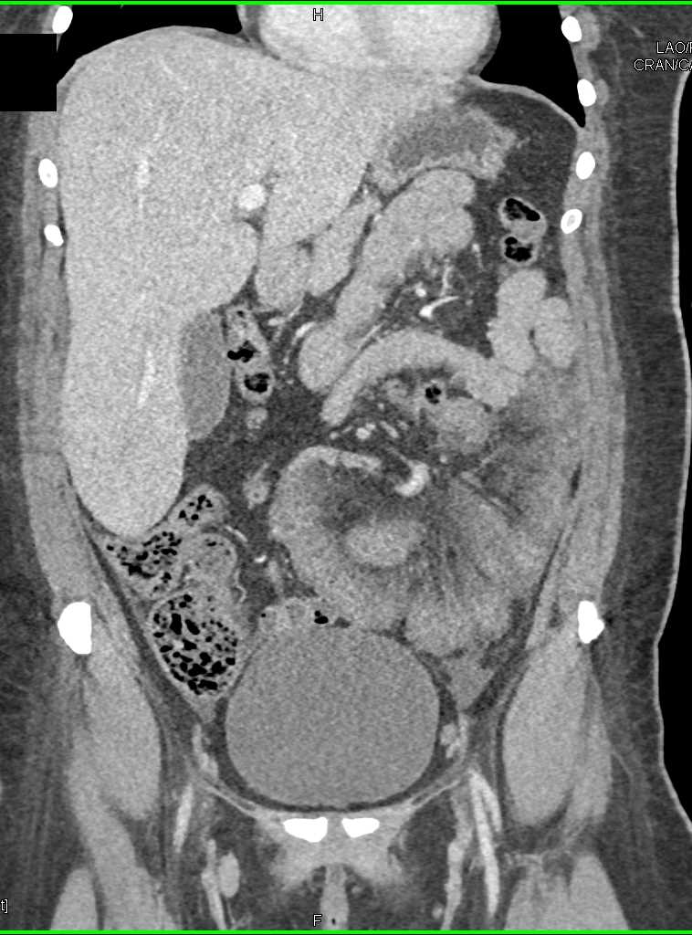 Inflammation of Small Bowel in Left Lower Quadrant - CTisus CT Scan