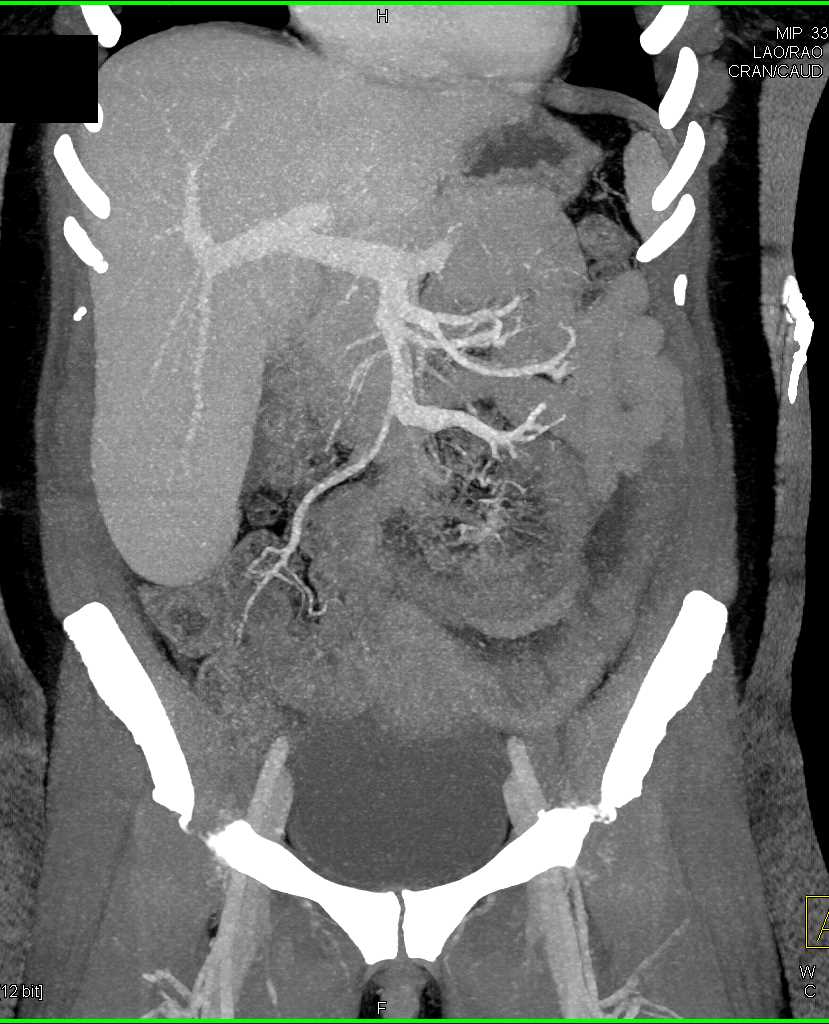 Inflammation of Small Bowel in Left Lower Quadrant - CTisus CT Scan