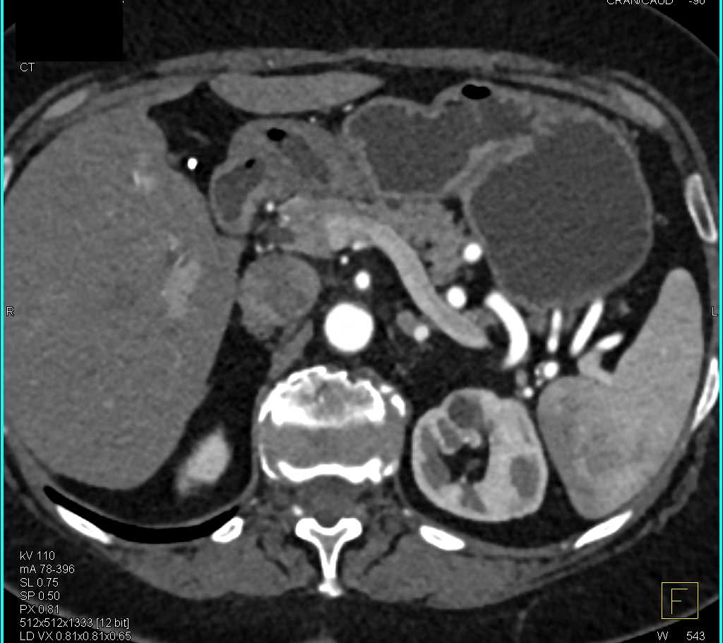 Ectopic Neuroendocrine Tumor - CTisus CT Scan