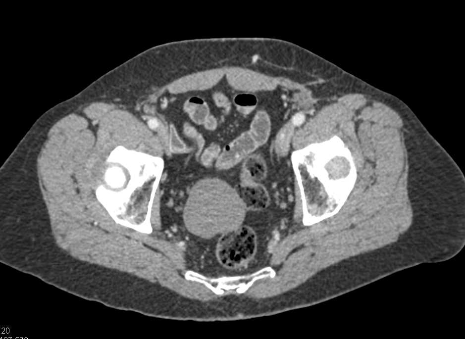 Small Bowel GIST Tumor - CTisus CT Scan