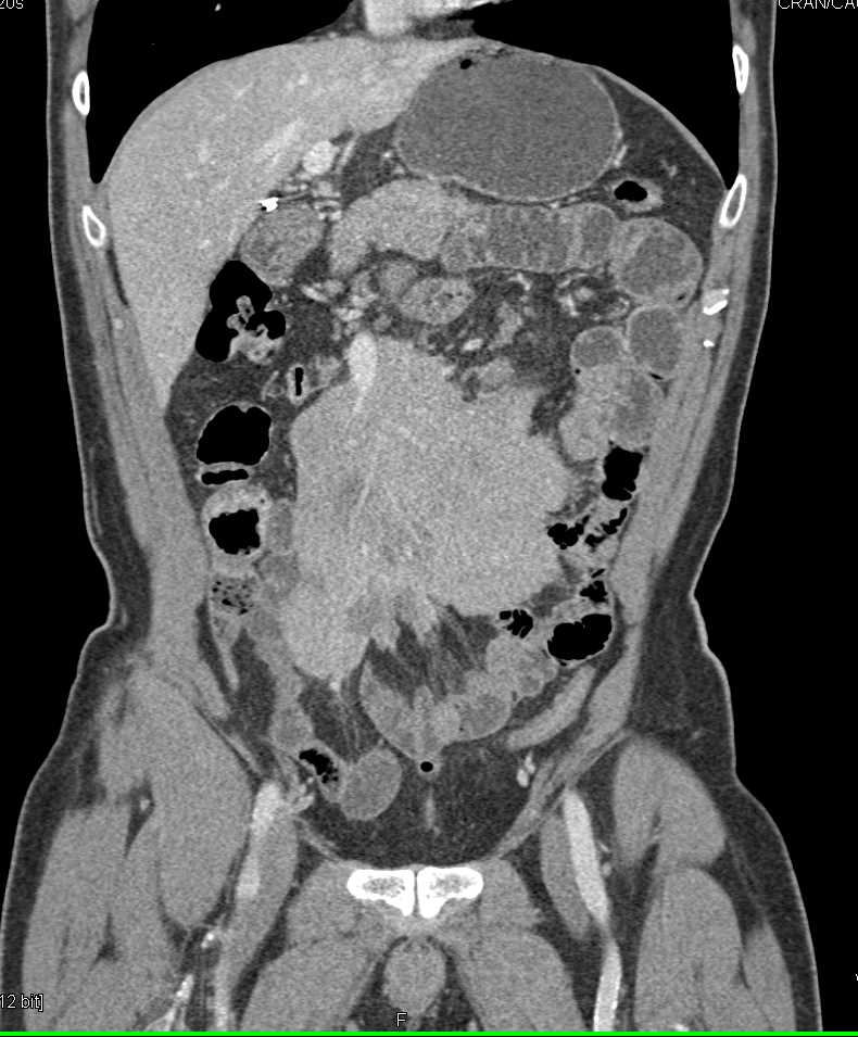 Small Bowel Lymphoma with Sandwich Sign - CTisus CT Scan