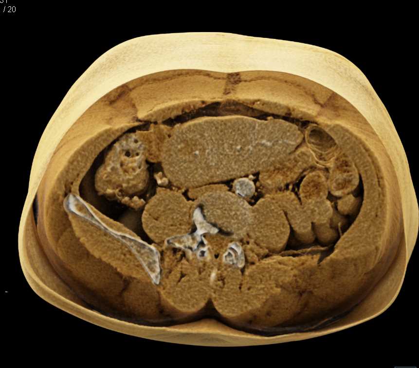 Small Bowel Lymphoma with Sandwich Sign - CTisus CT Scan
