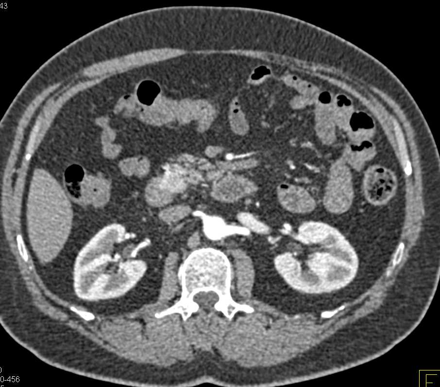 Carcinoid Tumor Duodenum - CTisus CT Scan