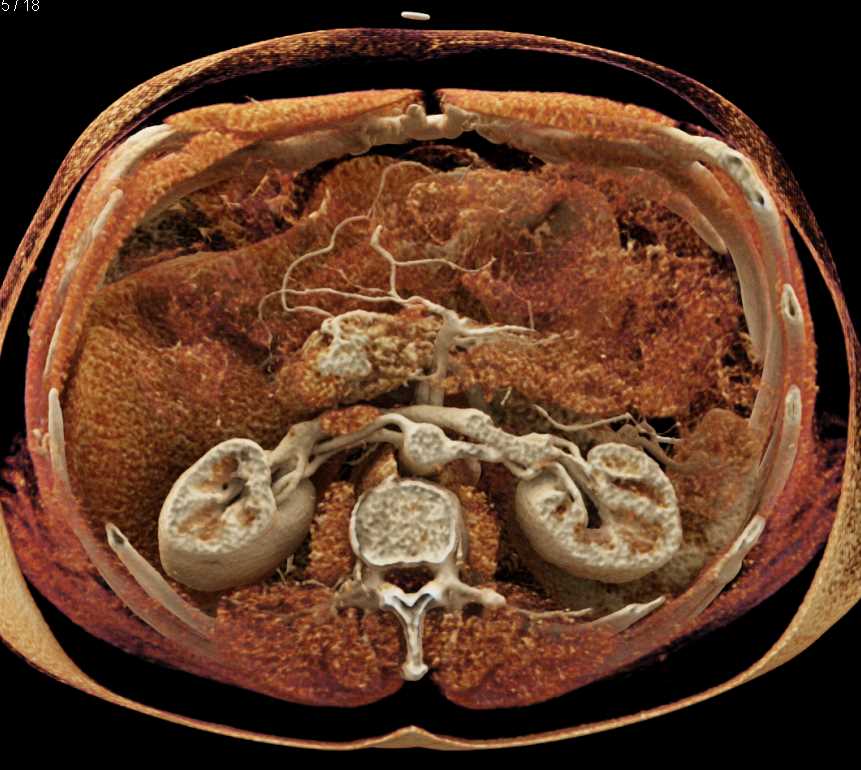 Carcinoid Tumor Duodenum with Cinematic Rendering - CTisus CT Scan