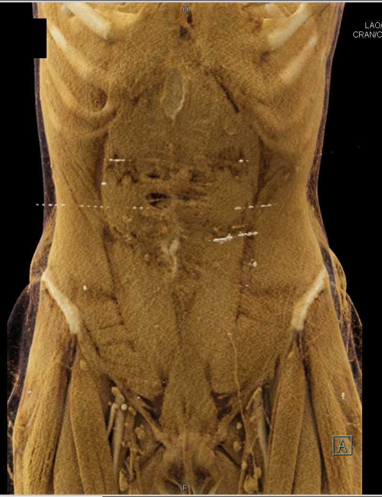 Small Bowel Enteritis - CTisus CT Scan