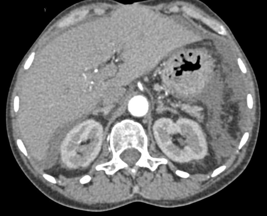 Small Bowel Enteritis - CTisus CT Scan