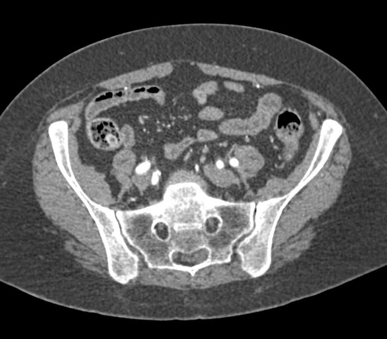 Crohn's Disease - CTisus CT Scan