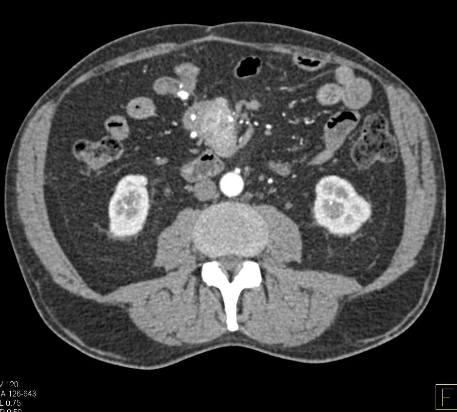 Small Bowel Carcinoid Tumor with Liver Metastases - CTisus CT Scan