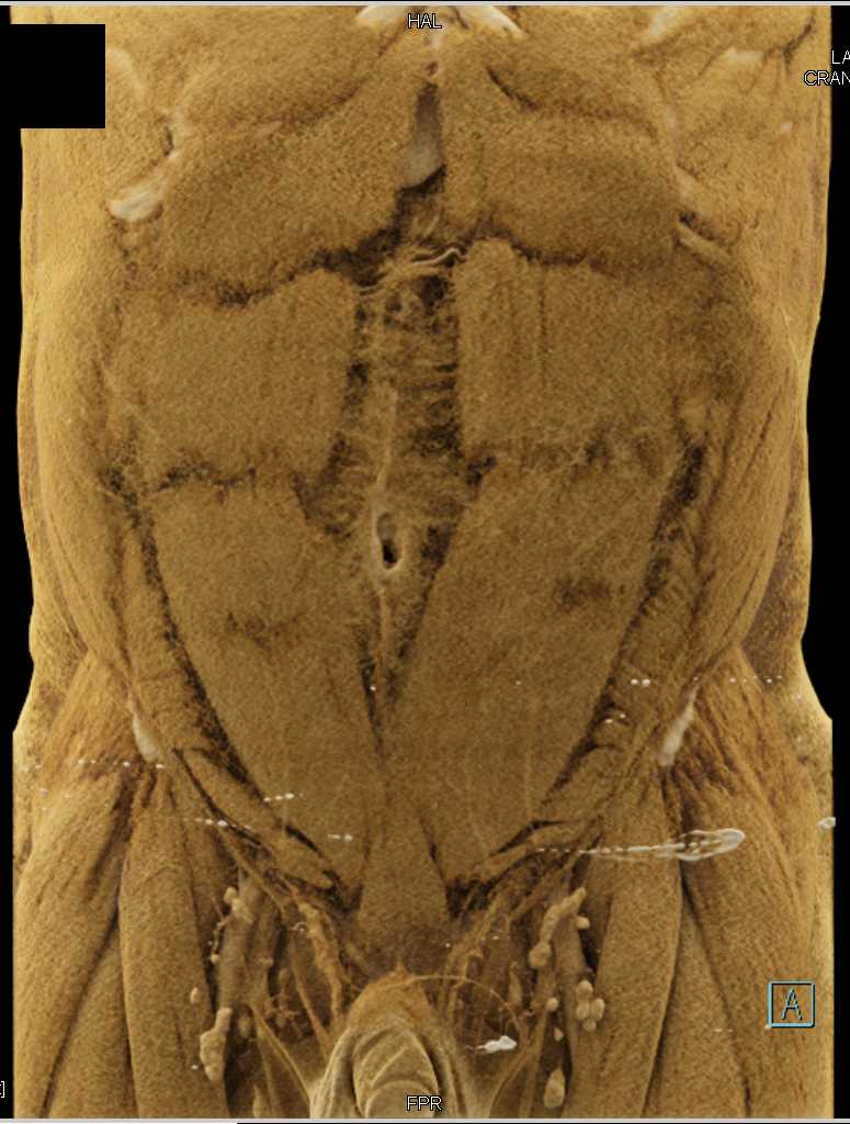 Small Bowel Carcinoid Tumor with Liver Metastases - CTisus CT Scan