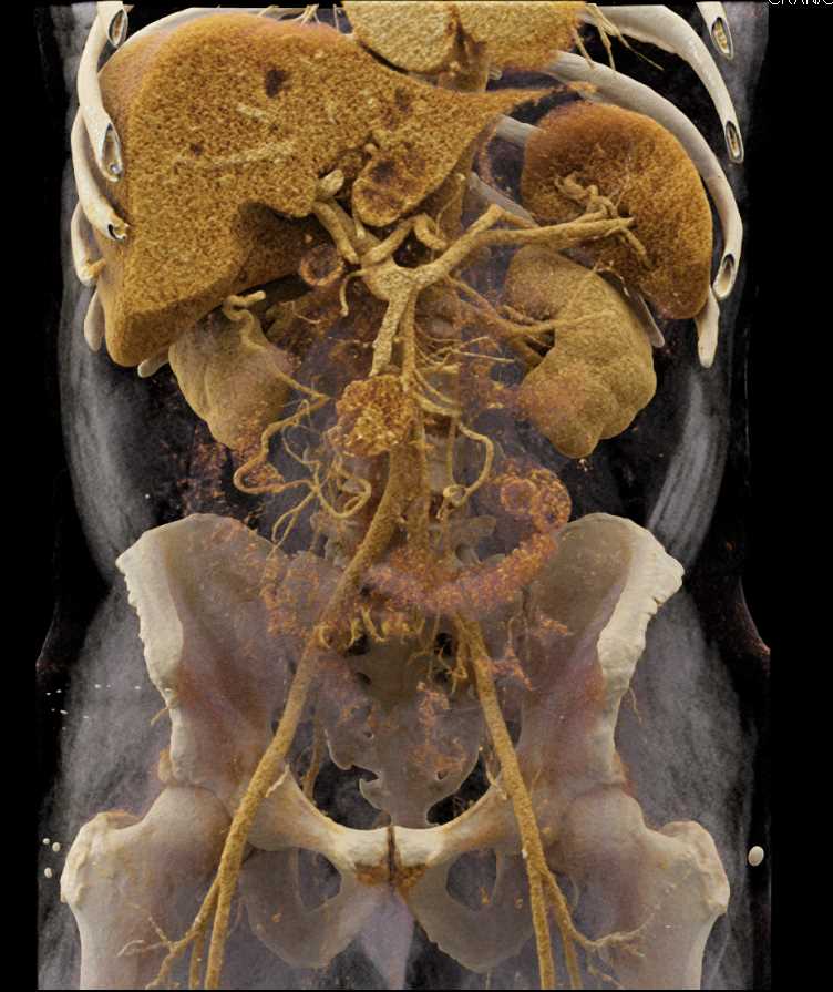 Small Bowel Carcinoid Tumor with Liver Metastases - CTisus CT Scan