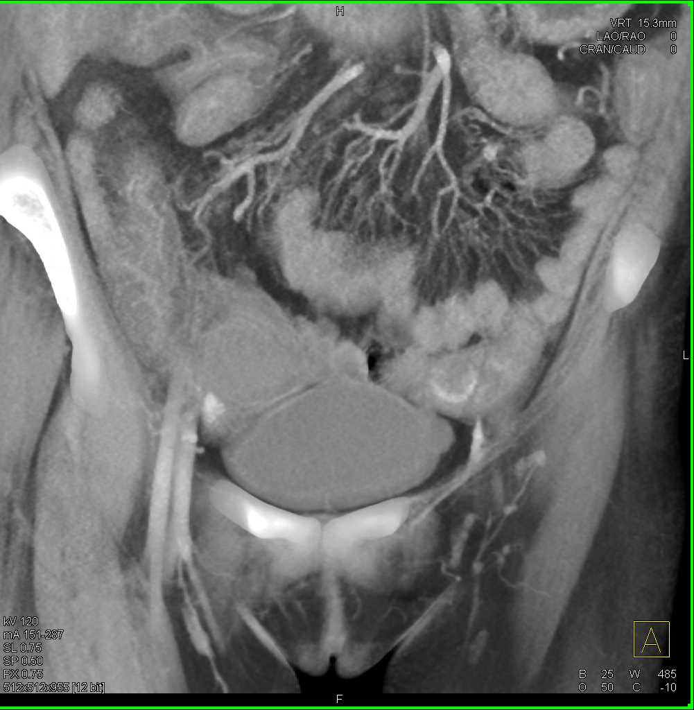 Small Bowel Enteritis with Bleed - CTisus CT Scan