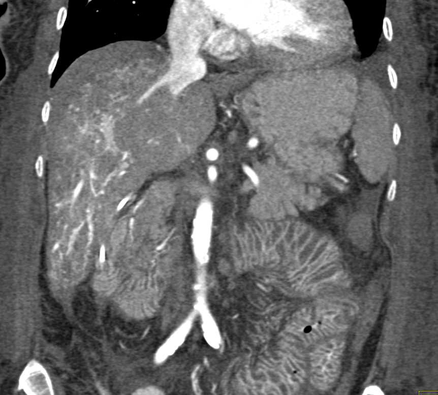 CTisus CT Scanning | Dilated Small Bowel due to Sprue