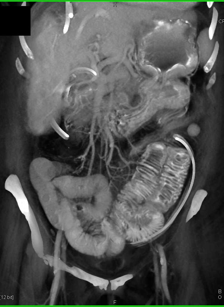 Dilated Small Bowel due to Sprue - CTisus CT Scan