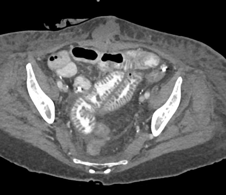 Dilated Small Bowel due to Sprue - CTisus CT Scan