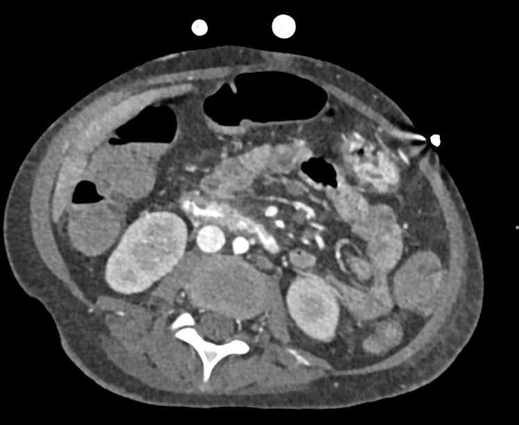 Active Bleed in the Duodenum - CTisus CT Scan