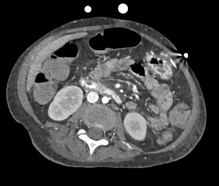 Active Bleed in the Duodenum - CTisus CT Scan