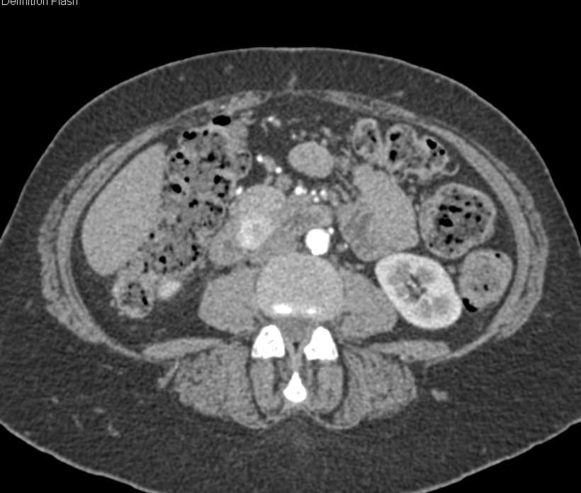 Duodenal GIST Tumor looks like Pancreatic Neuroendocrine Tumor (PNET) - CTisus CT Scan