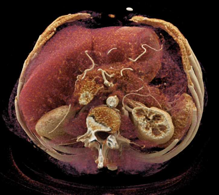 Duodenal GIST Tumor looks like PNET - CTisus CT Scan