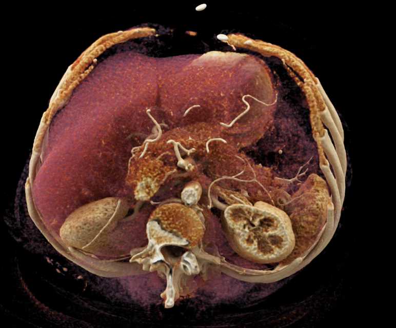 Duodenal GIST Tumor looks like PNET - CTisus CT Scan