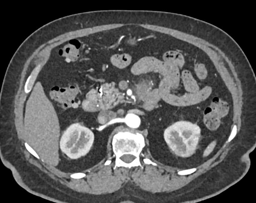 Carcinoid Tumor Mesentery - CTisus CT Scan