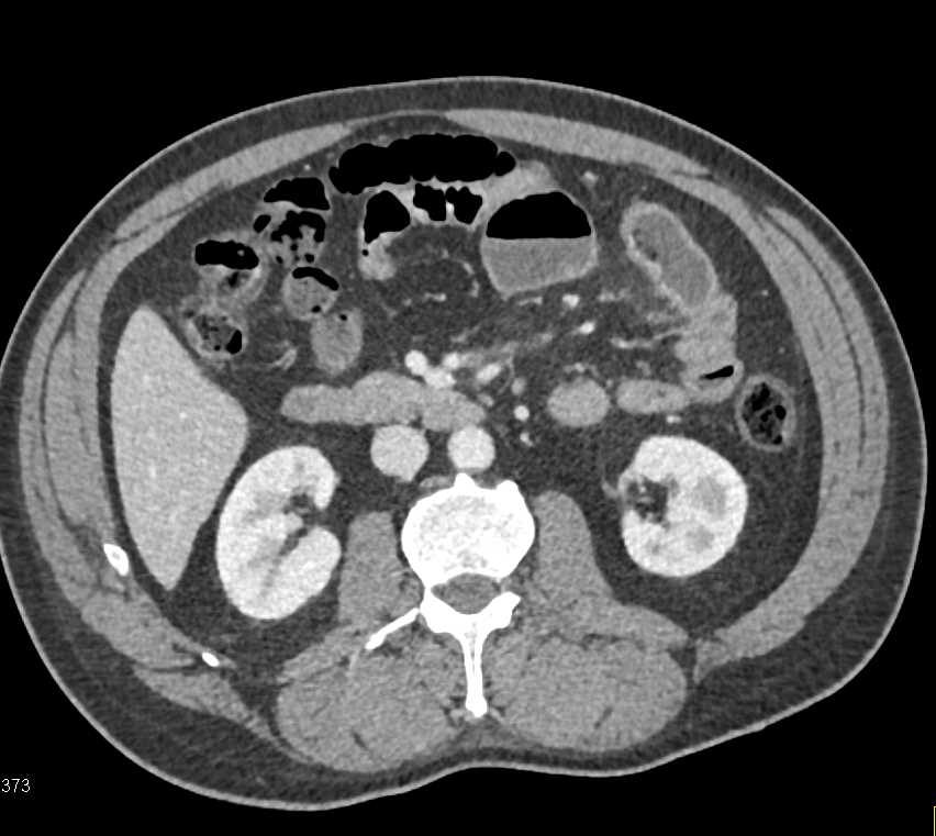 Adenocarcinoma Small Bowel - CTisus CT Scan