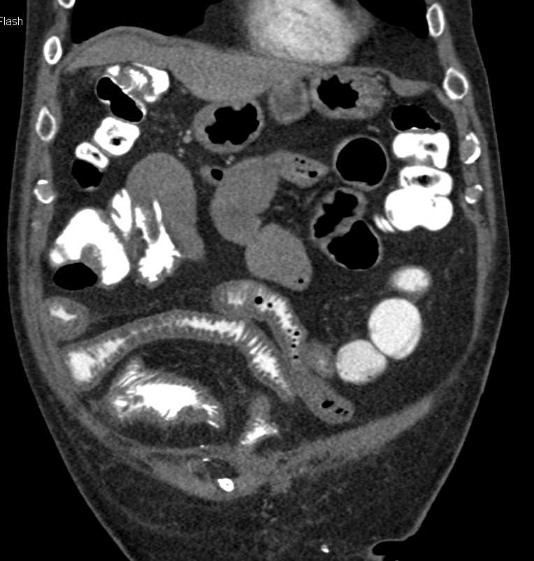 Small Bowel Enteritis - CTisus CT Scan