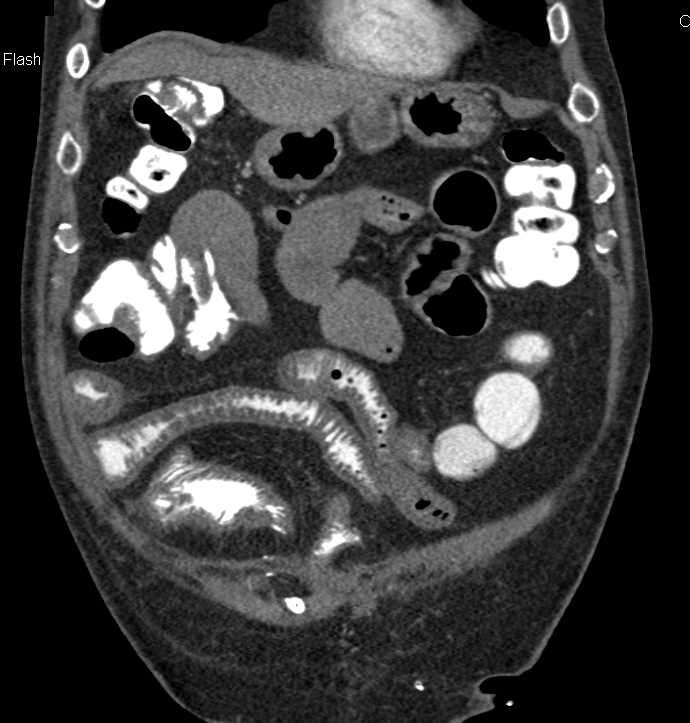 Small Bowel Enteritis - CTisus CT Scan