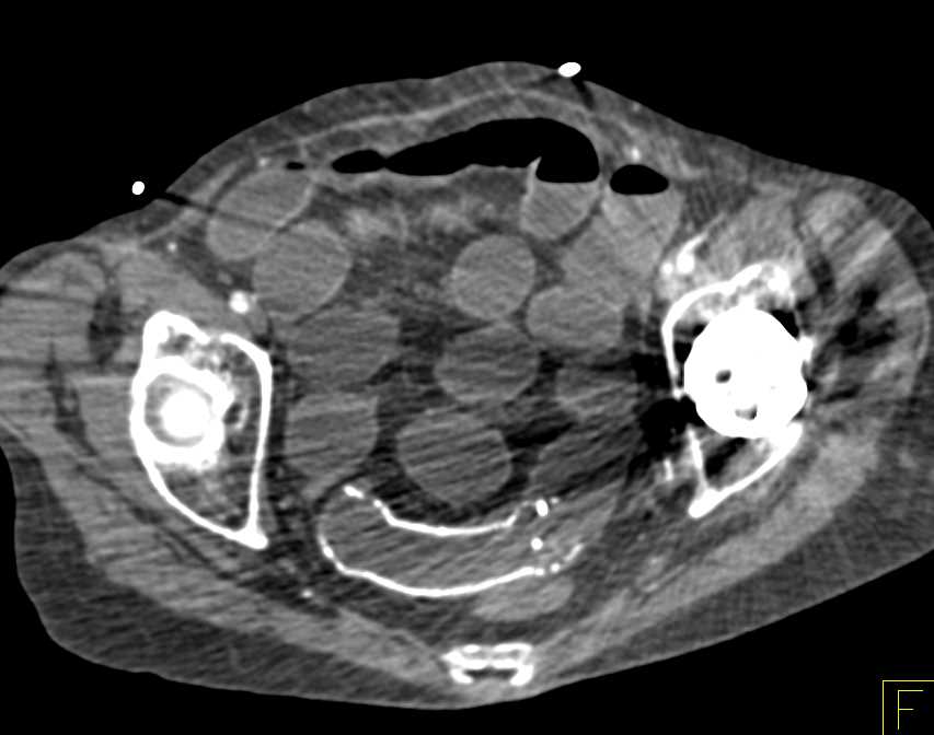 Small Bowel Obstruction (SBO) with Stent in the Small Bowel - CTisus CT Scan