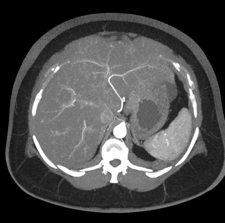 Carcinoid Tumor Root of Mesentery with Desmoplastic Reaction - Small ...