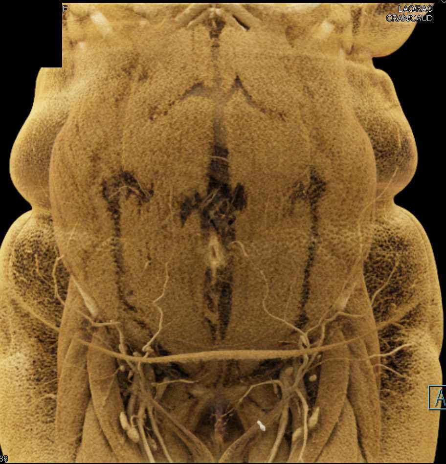 Carcinoid Tumor with Desmoplastic Reaction Right Lower Quadrant - CTisus CT Scan