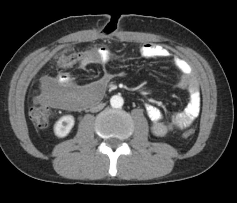 Small Bowel Ischemia due to Small Bowel Volvulus - CTisus CT Scan