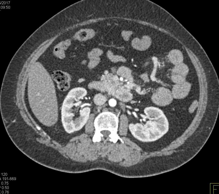 Duodenal Carcinoid Tumor with Adenopathy - CTisus CT Scan