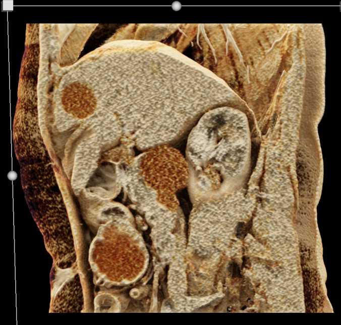 SMA Syndrome with Dilated Duodenum - CTisus CT Scan