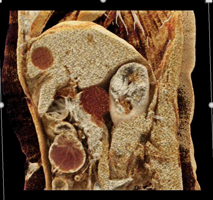 SMA Syndrome with Dilated Duodenum - CTisus CT Scan
