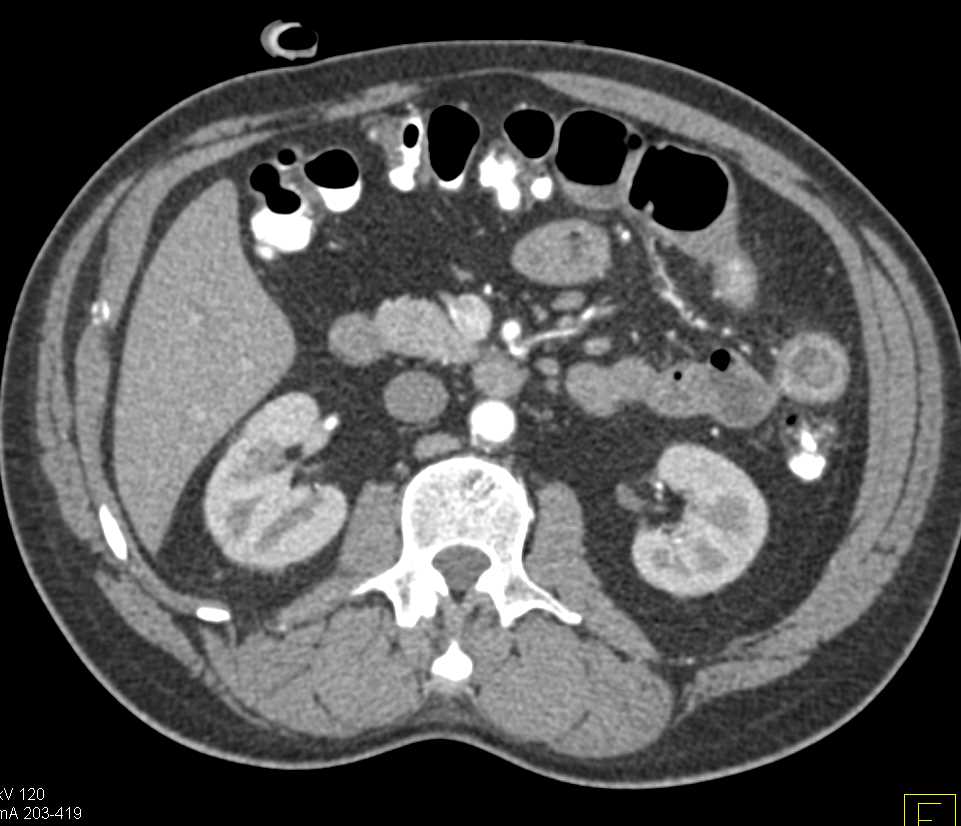 Enteritis Jejunal Folds - CTisus CT Scan