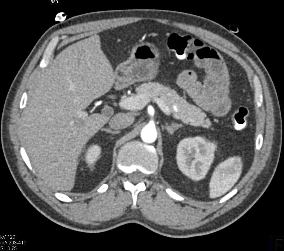 Small Nodes in the Root of the Mesentery - CTisus CT Scan