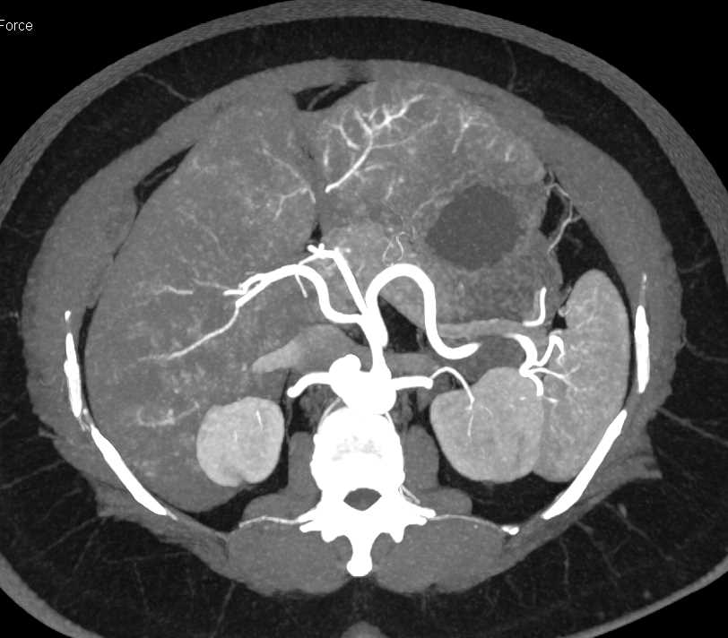 Small Bowel Carcinoid Tumor with Desmoplastic Reaction - CTisus CT Scan