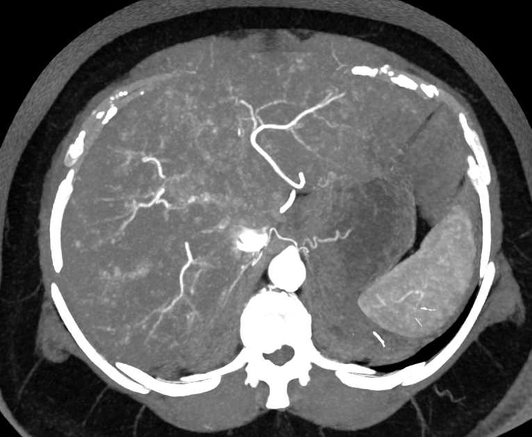 Small Bowel Carcinoid Tumor with Desmoplastic Reaction - CTisus CT Scan