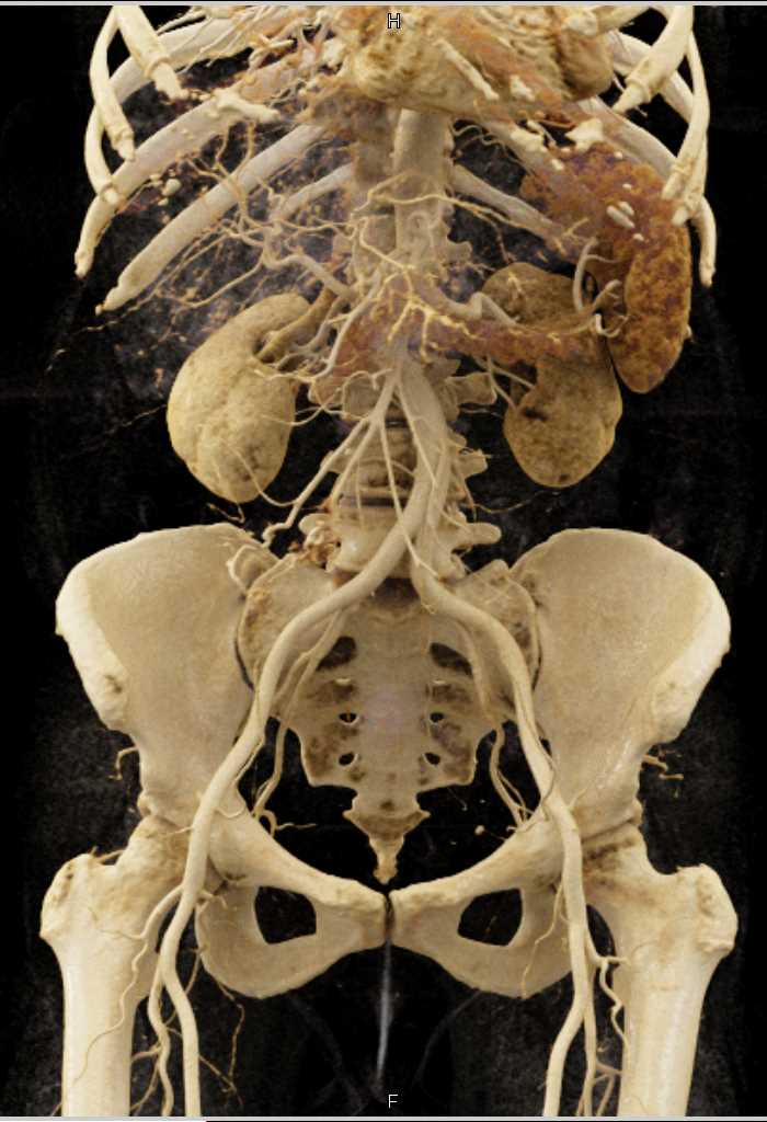 Small Bowel Carcinoid Tumor with Desmoplastic Reaction with Cinematic Rendering (CR) - CTisus CT Scan