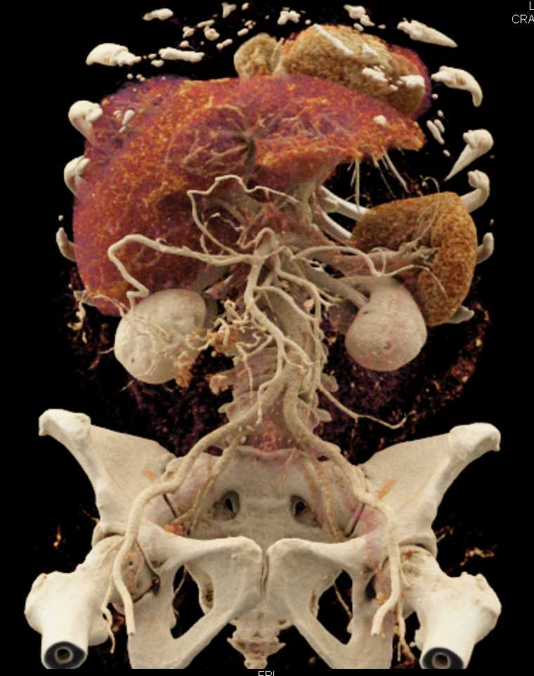 Small Bowel Carcinoid Tumor with Desmoplastic Reaction with Cinematic Rendering (CR) - CTisus CT Scan