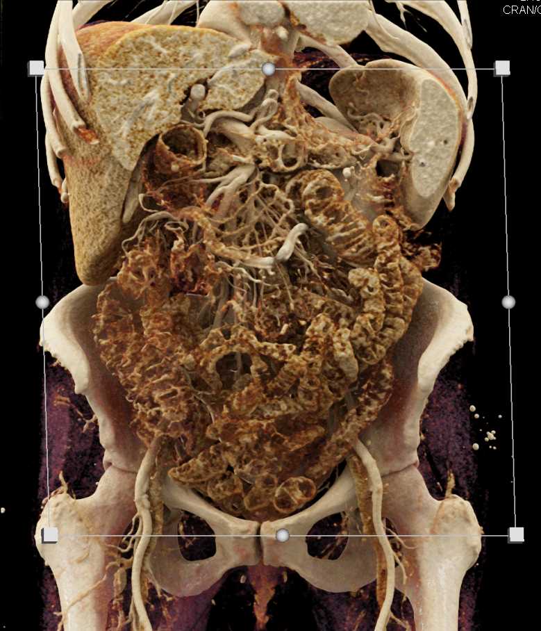 Cinematic Rendering of Small Bowel Folds - CTisus CT Scan