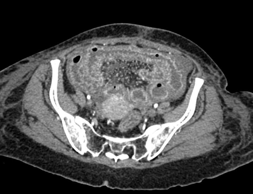 Ischemic Small Bowel Wall Changes - CTisus CT Scan