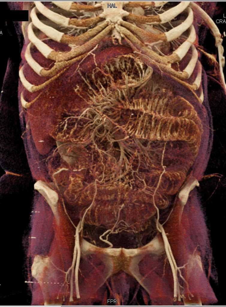 Small Bowel Obstruction - CTisus CT Scan